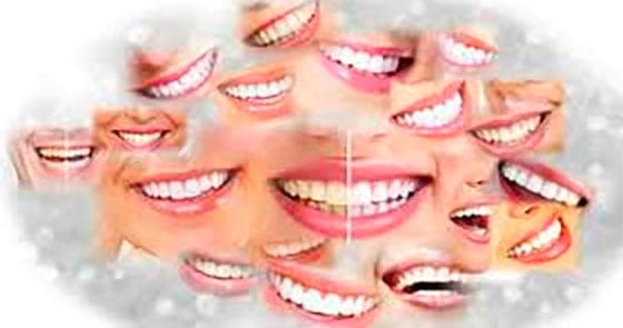 Cloud of Whiter Smiles - Teeth Bleaching - White Teeth Obsession
